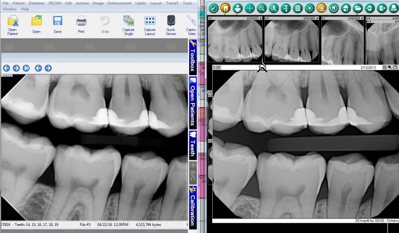 Apex Dental Sensor VS Dexis